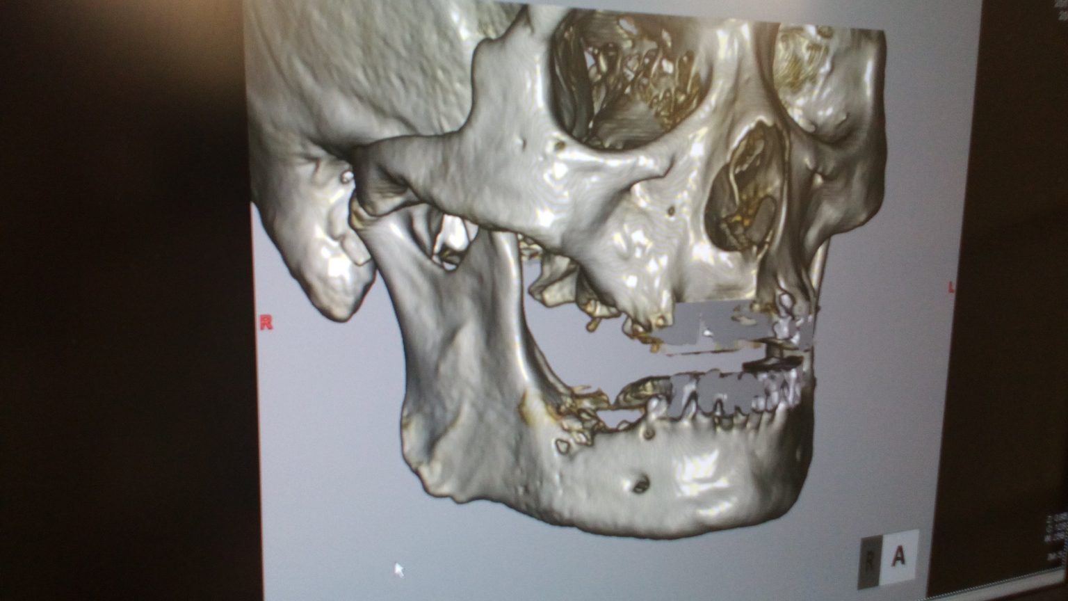 Bulto debajo de la mandibula